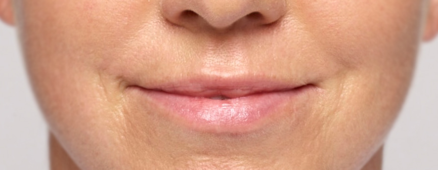 Alanna After Restylane 2