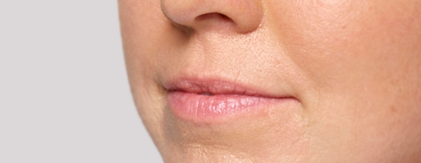 Alanna Before Restylane
