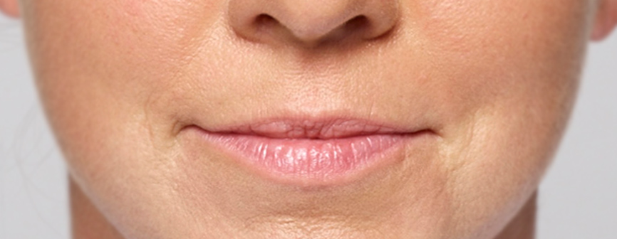 Alanna Before Restylane 2