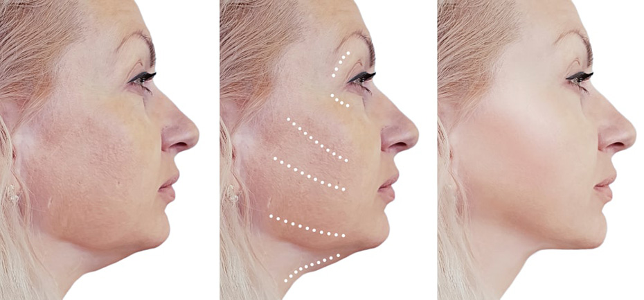 platysmaplasty