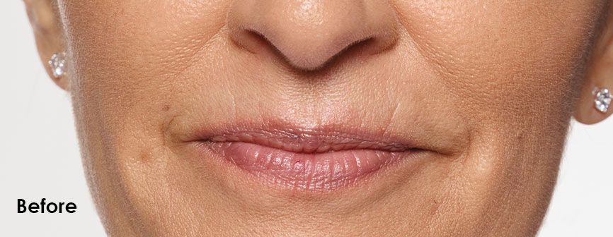 carol Before Restylane