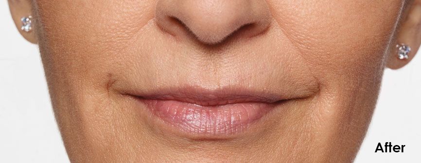 carol After Restylane